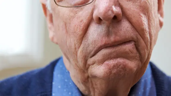 Gesicht eines älteren Mannes mit einer Fazialisparese - ein Mundwinkel hängt herunter (Bild: IMAGO/ingimage) | IMAGO/ingimage, ingimage Gesicht eines älteren Mannes mit einer Fazialisparese - ein Mundwinkel hängt herunter (Bild: IMAGO/ingimage)