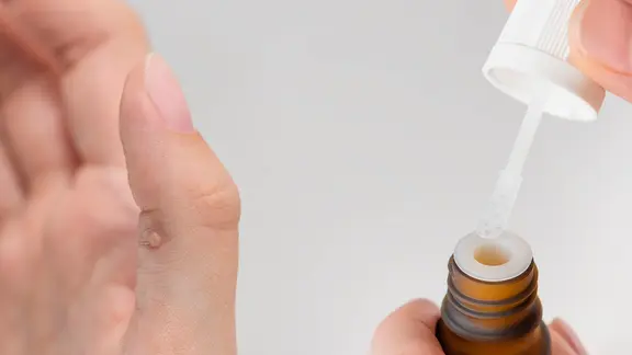 Warzen entfernen: Hausmittel, Apotheke oder Hautarzt? | ndr.de