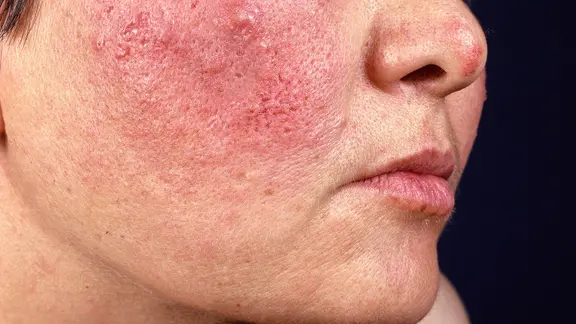 Akne inversa: Ursachen und Behandlung schmerzender Knoten | ndr.de