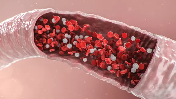 Eine Arterie, durch die rote Blutplättchen fließen und bei der weiße Plaques für die Verkalkung der Arterie sorgen.