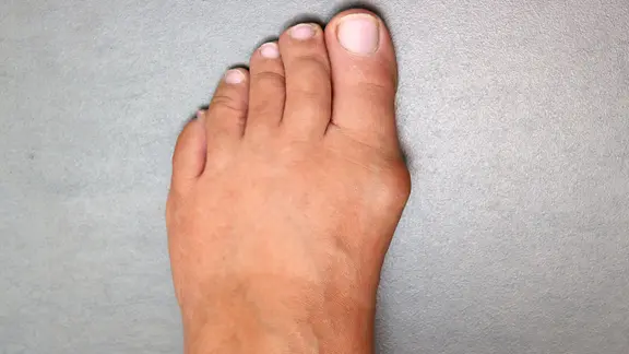 Weiblicher Fuß mit Ballenzeh (Hallux Valgus) steht auf grauem Boden