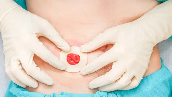 Stoma: Ein Leben mit knstlichem Darmausgang | ndr.de