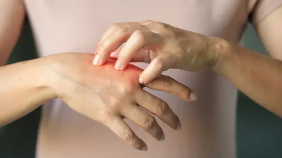 Eine Hand kratzt den Ausschlag der anderen. | ipopba / PantherMedia, ipopba Eine Hand kratzt den Ausschlag der anderen.