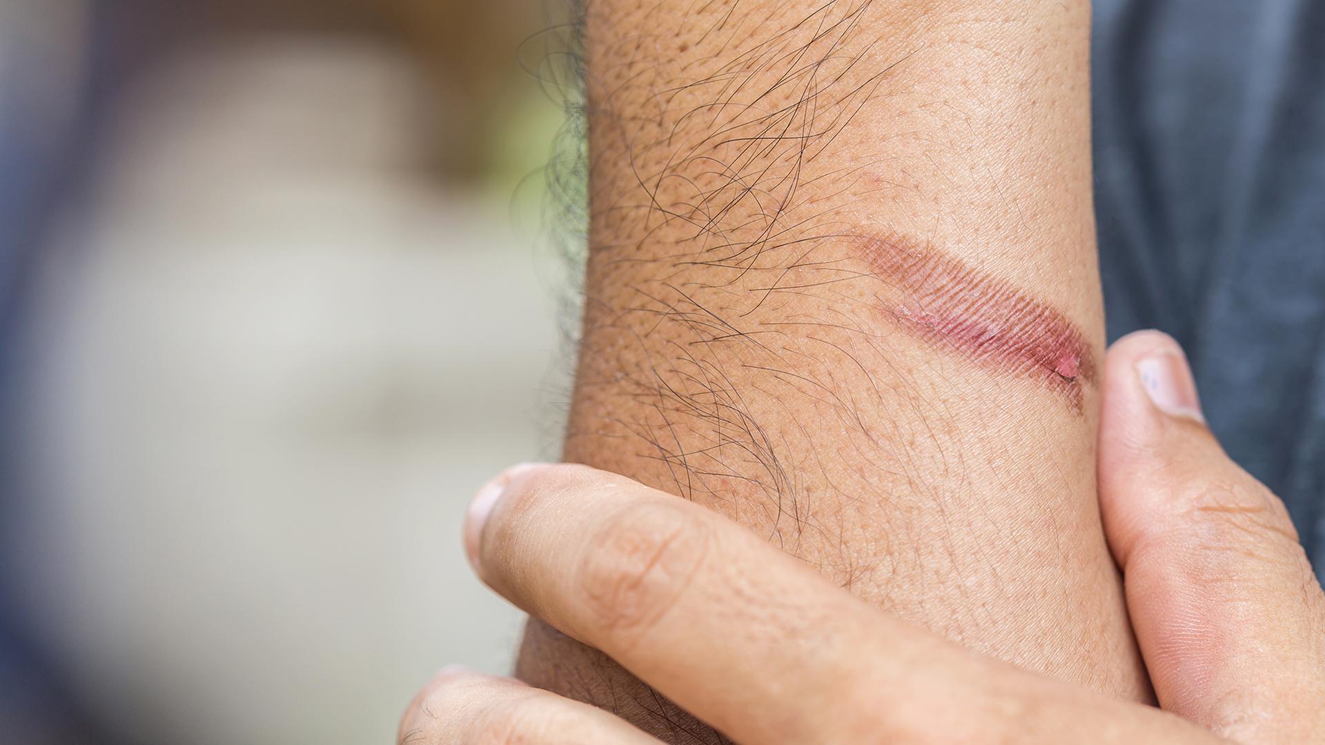 Ein Mann hält sich den Unterarm an dem sich eine Verbrennung sichtbar ist | colourbox, Phanuwat Nandee