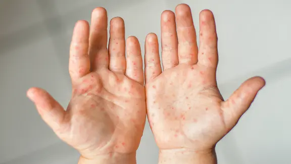 Symptom der Hand-Fuß-Mund-Krankheit: Hautausschlag mit getrockeneten Bläschen an den Händen