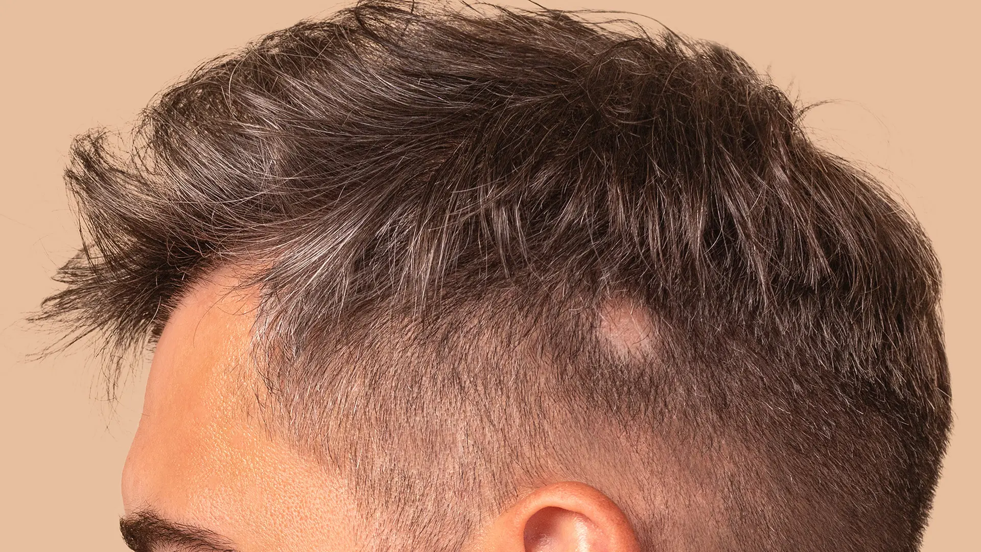 Alopecia areata: Cause, treatment and progression