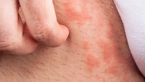 Nesselsucht: Hand kratzt an Ausschlag auf Bein | imago images/ Shotshop Nesselsucht: Hand kratzt an Ausschlag auf Bein