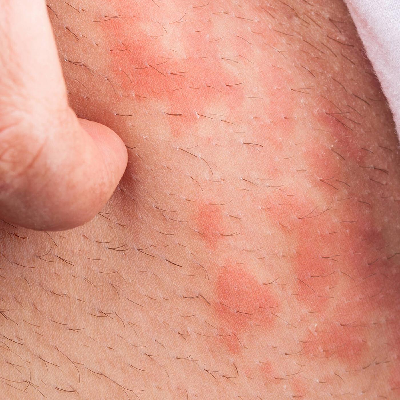 Nesselsucht: Symptome, Ursache und Behandlung | ndr.de