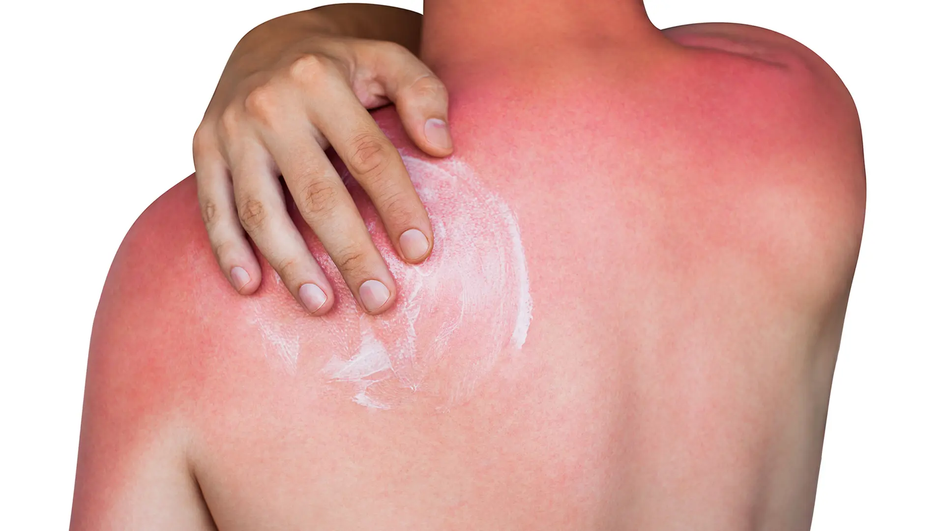 Sonnenbrand: Hautschden durch Sonne erkennen und verhindern | ndr.de