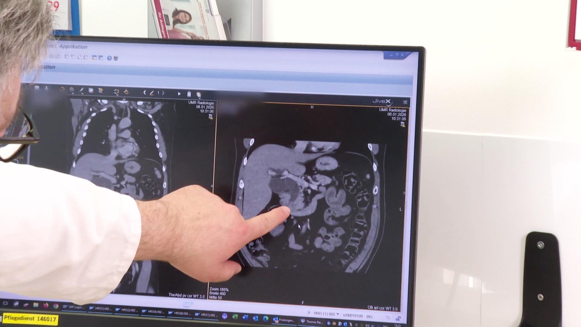 Bauspeicheldrüsenkrebs wird oft spät erkannt
