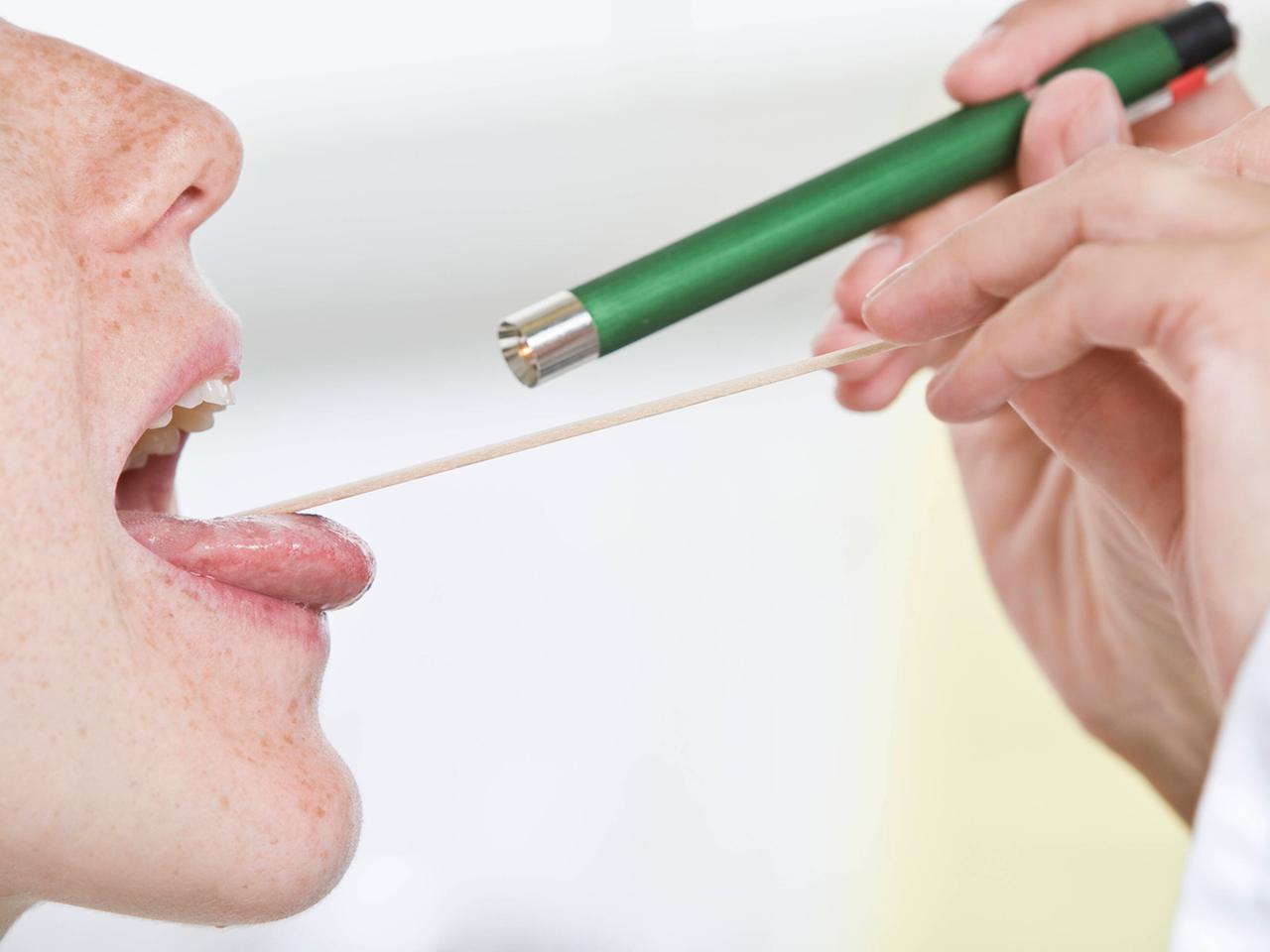 Amoxicillin für angina
