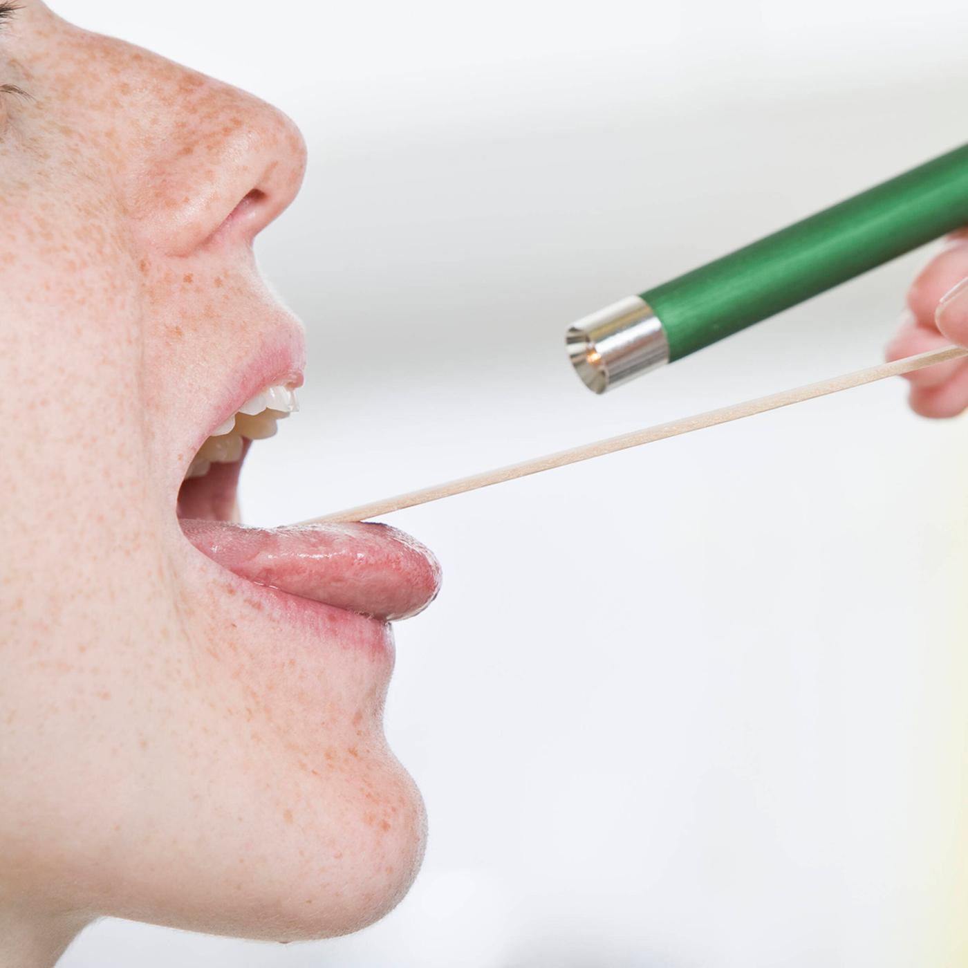 Mandelentzündung: Was hilft bei einer Tonsillitis?
