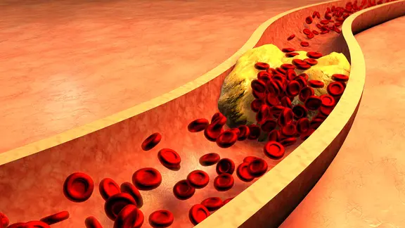 Verstopfte Arterie mit Blutplättchen und Cholesterin-Plaque dargestellt in einer Grafik.