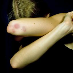 Junge Frau verschränkt ihre Arme vorm Gesicht. An den Ellenbogen sind blaue Flecke.