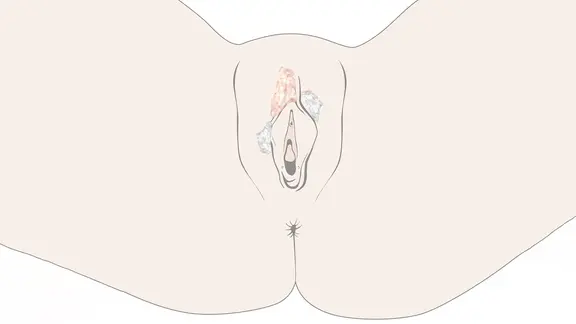lichen sclerosus gleitgel Lichen sclerosus: Juckende Hautkrankheit im Intimbereich