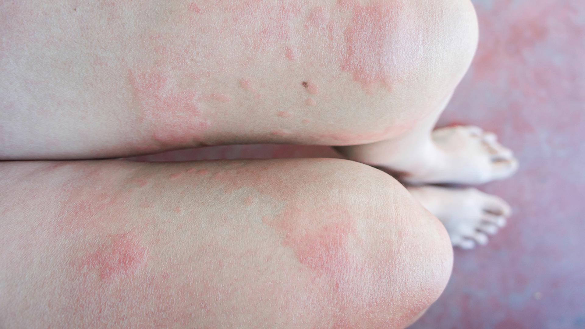 Autoimmunkrankheit Lupus erythematodes greift Haut und Organe an