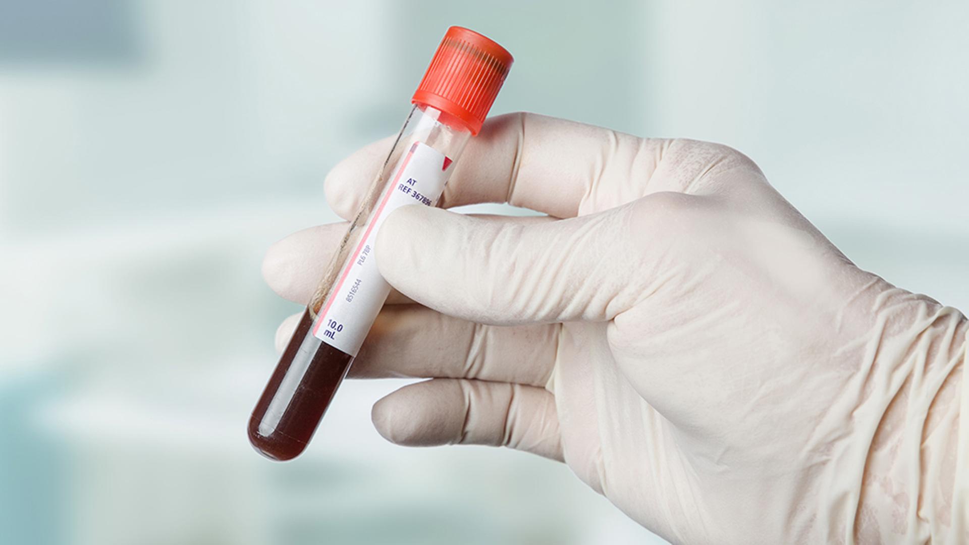 glutathion-mangel symptome haut Glutathion-S-Transferase-Mangel: Wenn die Entgiftung gestört ist IV Therapy | Progressive