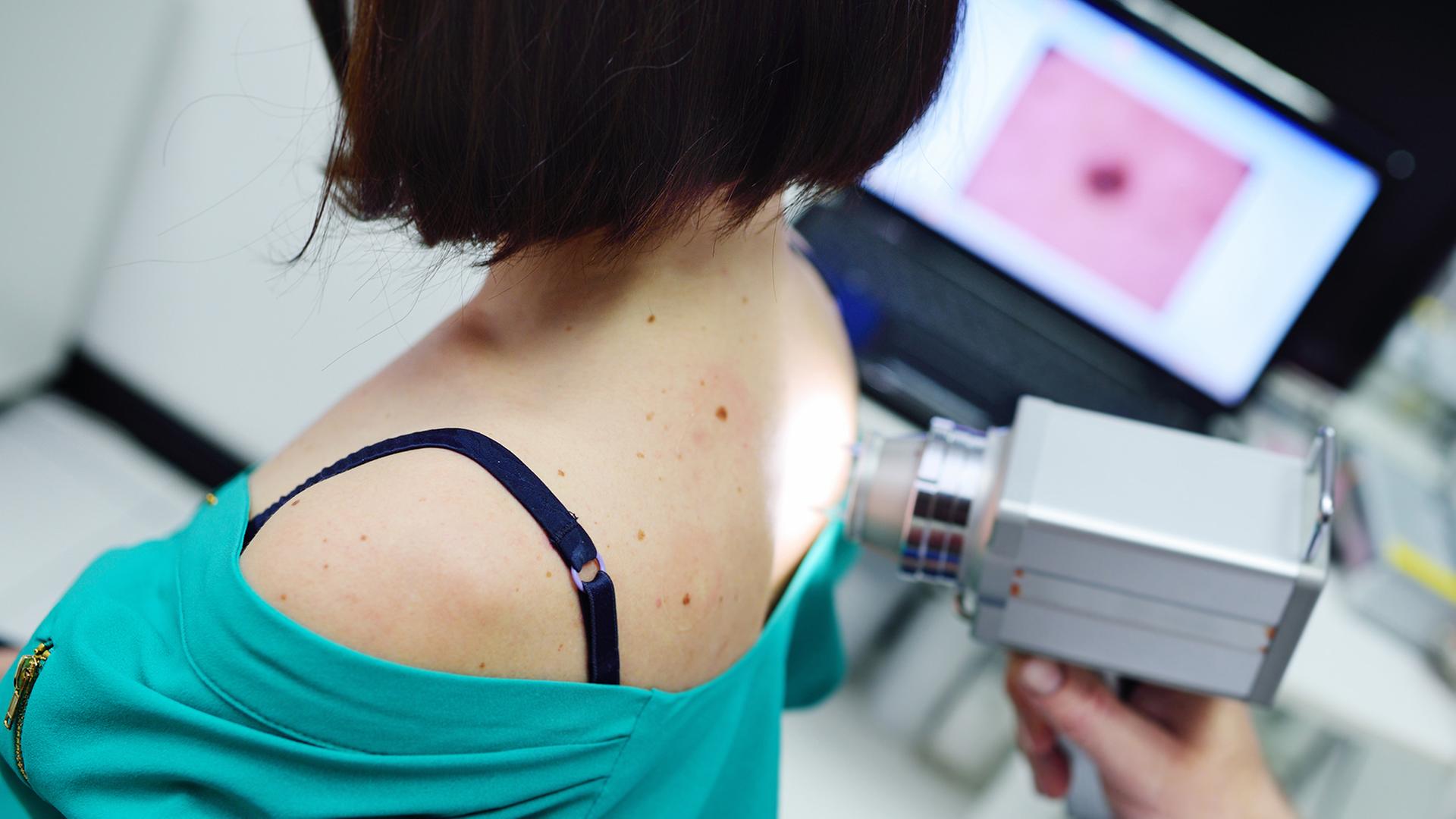 Hautkrebs: Klinikfälle in SH haben sich mehr als v