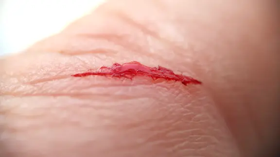 Bild zeigt Schnittwunde auf Haut einer Hand