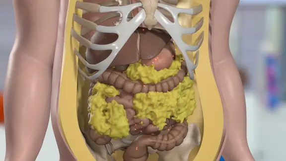 Das sogenannte viszerale Fett umgibt die inneren Organe und ist besonders gefährlich | NDR Schematische Darstellung: Bauchraum mit viel eingelagertem Fett.