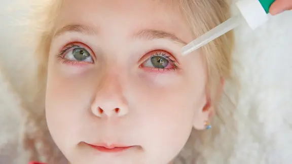 Gesicht eines Kindes mit gerötetem Auge, das Augentropfen erhält