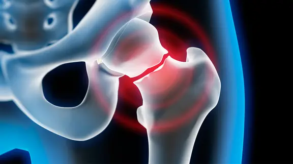 Grafische Darstellung eines Oberschenkelhalsbruchs