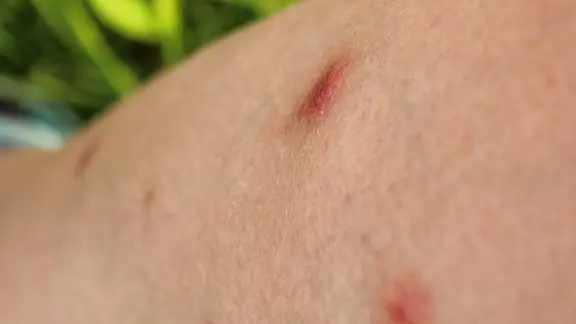 Ein Bein mit Mückenstichen in Nahaufnahme