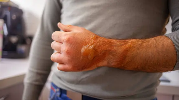 Ein Arm mit einer Brandverletzung oder Verbrennung