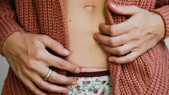 Frau zeigt ihre Kaiserschnittnarbe am Bauch