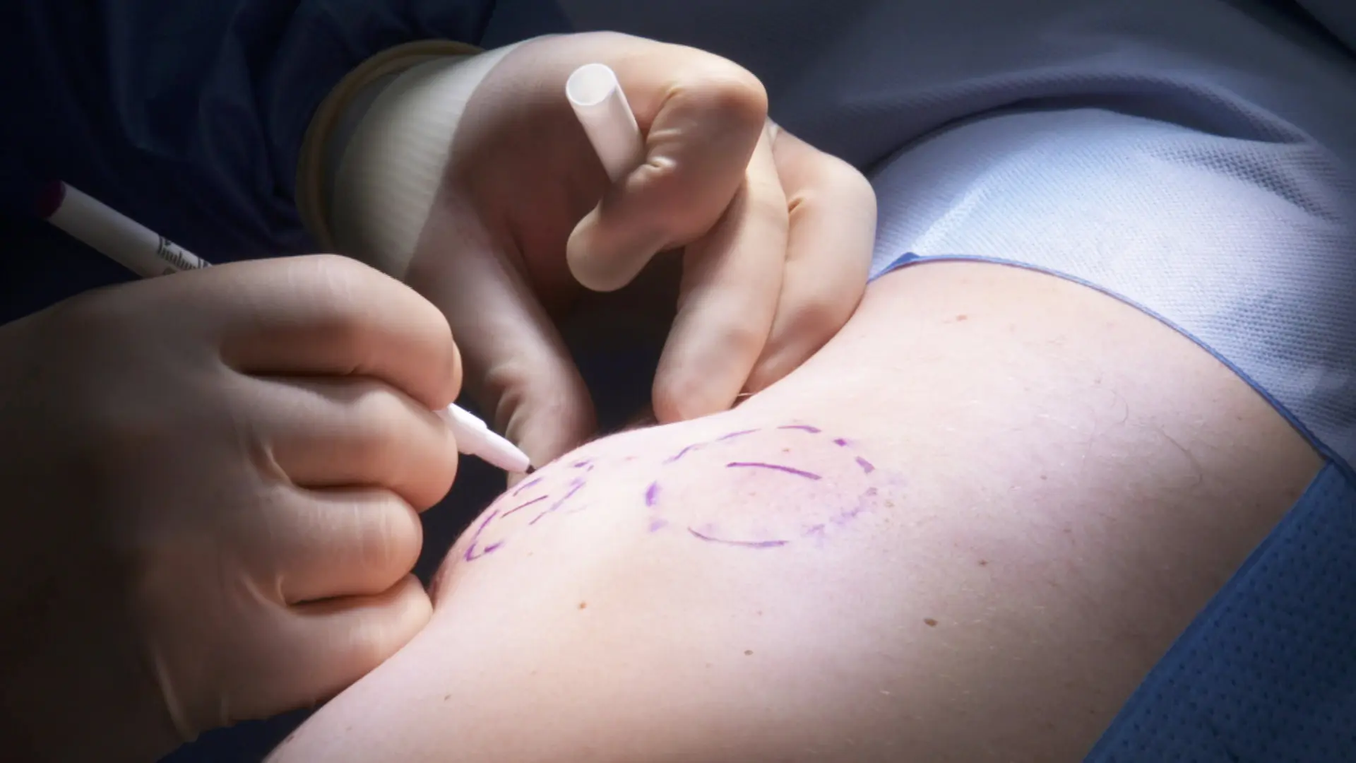 Verkapselter Fremdkörper Unter Der Haut www.ndr.de