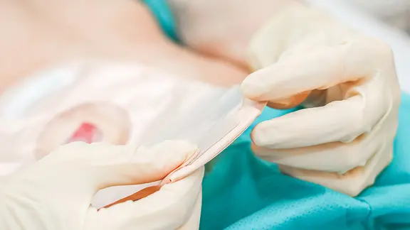 Ein Patient im Pyjama mit offenem Bauch rollt das untere Ende des Kolostomiebeutels zusammen. | PantherMedia, Nataliya (YAYMicro) Ein Patient im Pyjama mit offenem Bauch rollt das untere Ende des Kolostomiebeutels zusammen.