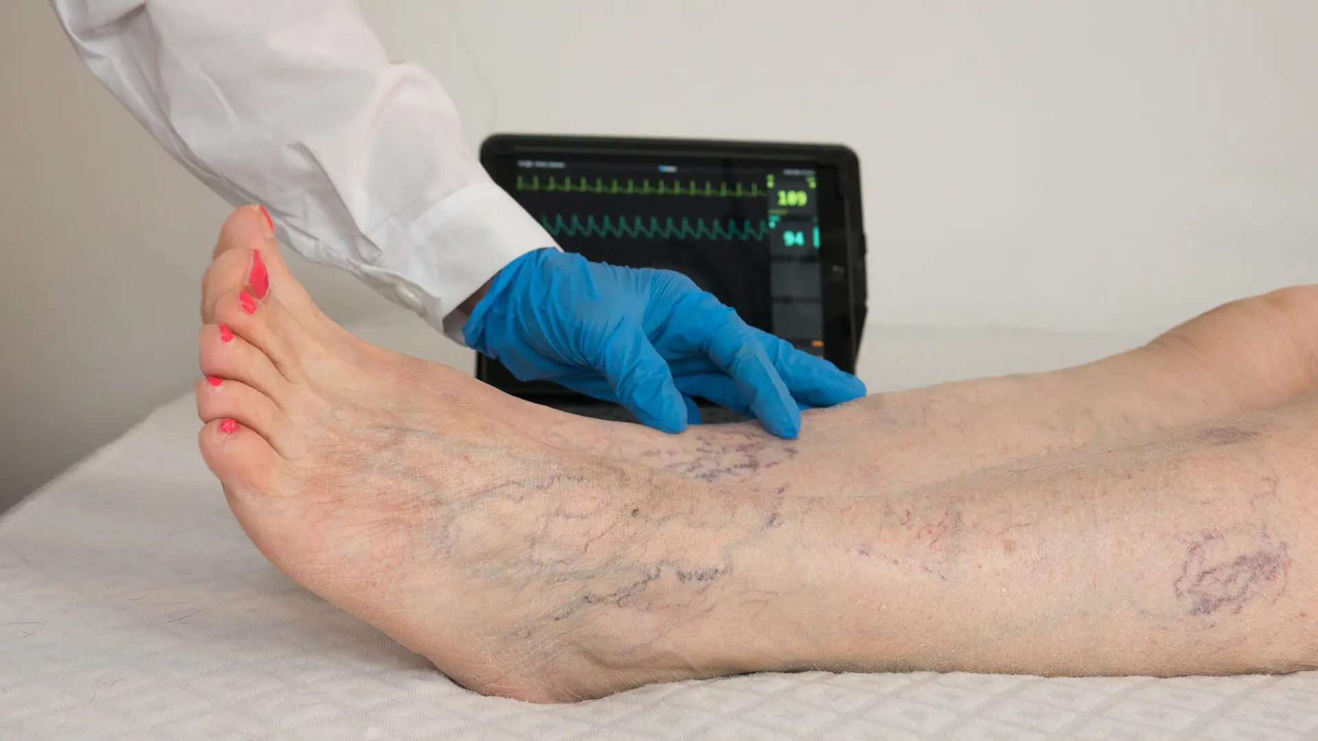 Removing varicose veins: Which therapies help with varicose veins?