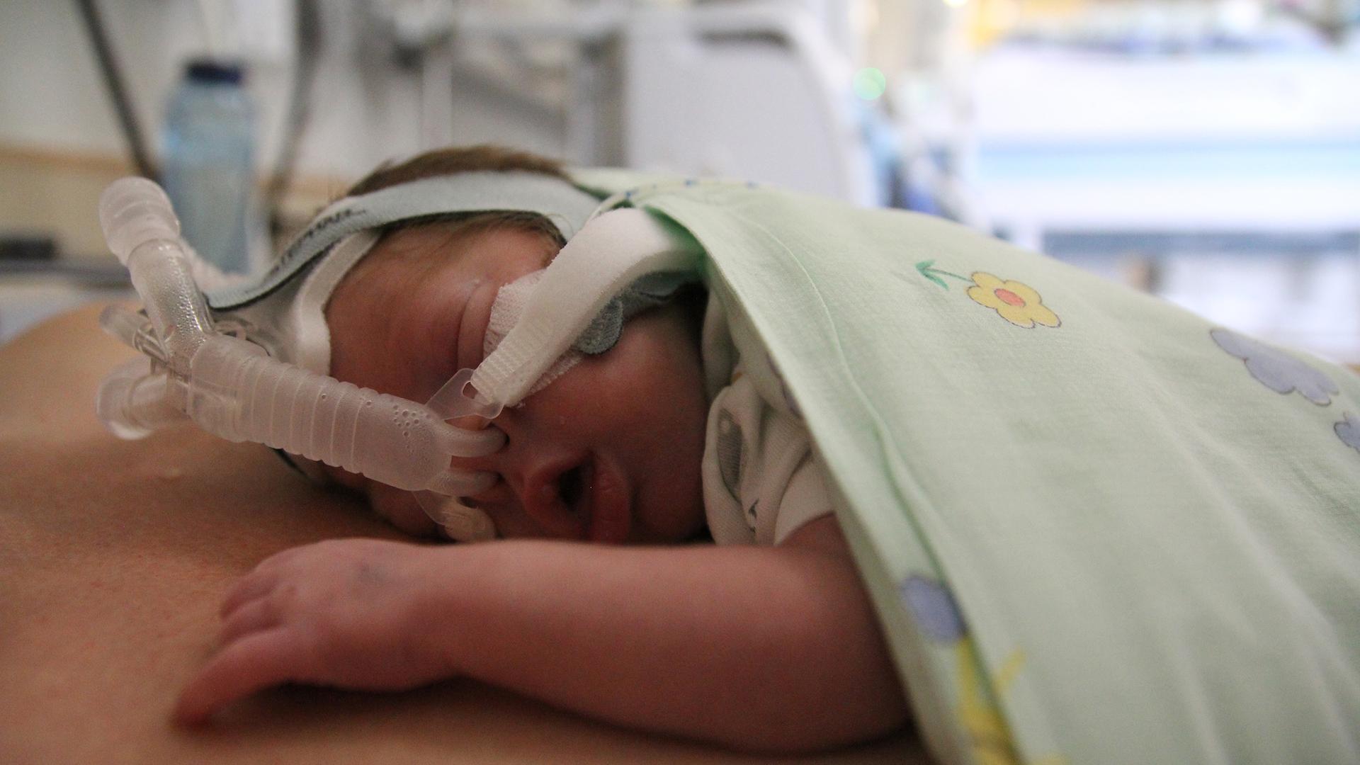 Frühchenbehandlung: Westküstenkliniken fürchten Einschränkungen