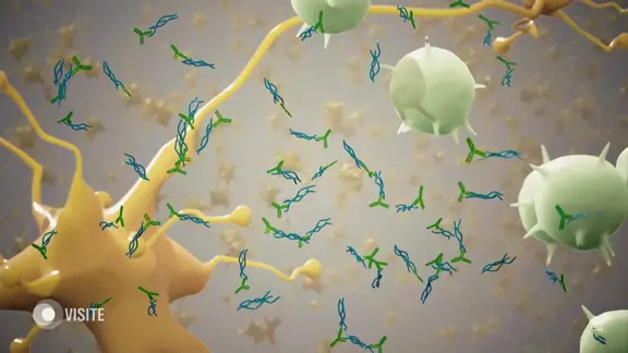 3D-Visualisierung: Antikörper binden an bestimmte Proteinfibrillen zwischen Nervenzellen im Gehirn.