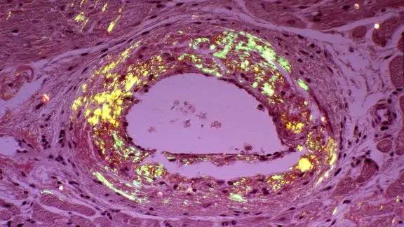 Kreislaufsystem Amyloidose Ablagerung von Proteine in Blutgefäß, Mikroaufnahme Querschnitt.