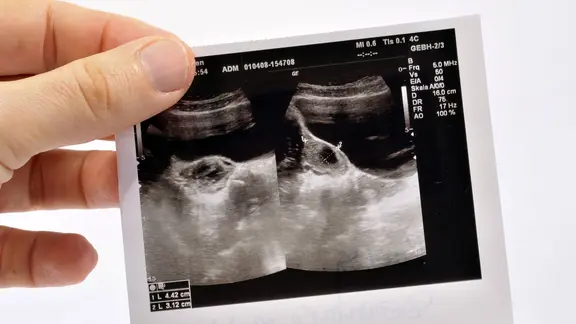 Hand mit Ultraschallfoto einer Zyste an einem Eierstock