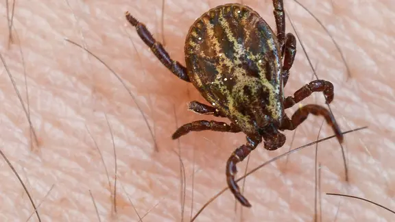 Das Bild zeigt eine Zecke auf menschlicher Haut.