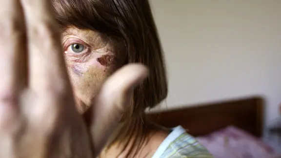 Eine ältere Frau hält sich die Hand vor`s Gesicht in dem man Verletzungen sieht.